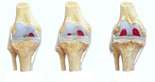 stages of knee osteoarthritis