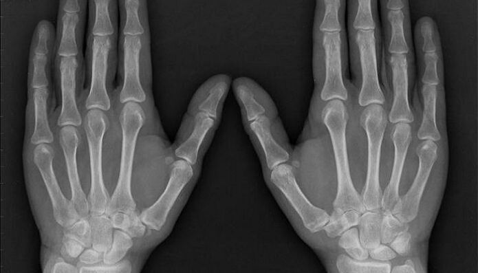 x-ray for the diagnosis of arthritis and arthrosis