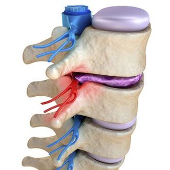 A pinched nerve in the spine is accompanied by shooting pains