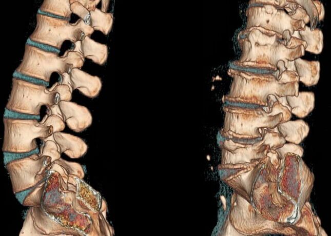 Osteochondrosis in the lumbar region