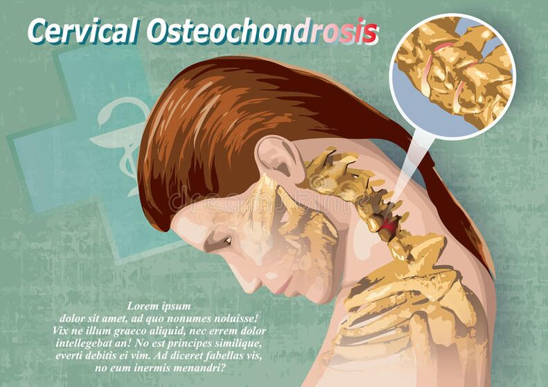 Cervical osteochondosis is a disease of the cartilage fabric