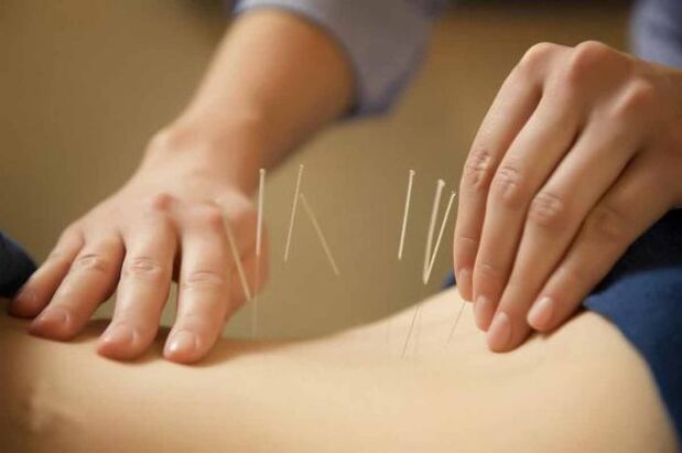 treatment of osteochondrosis with acupuncture