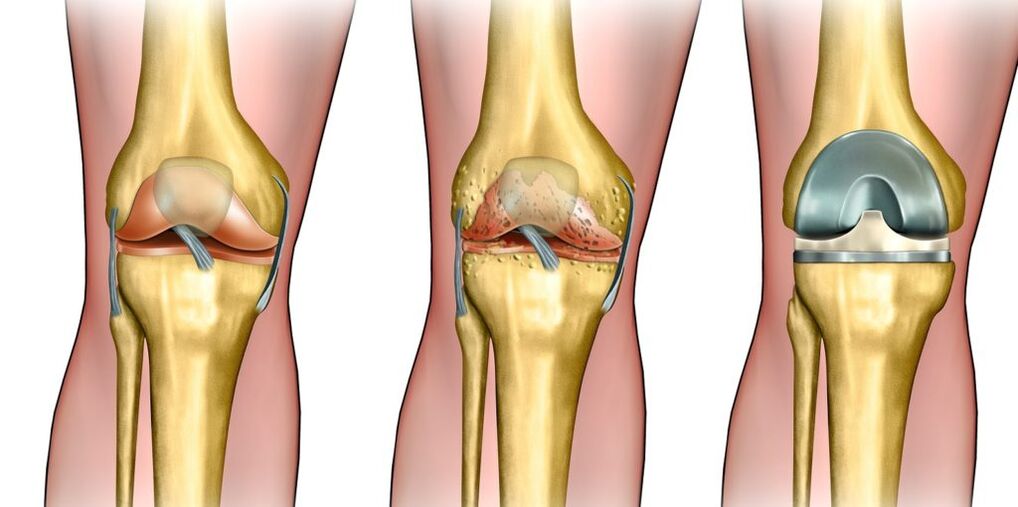 osteoarthritis of the knee joint