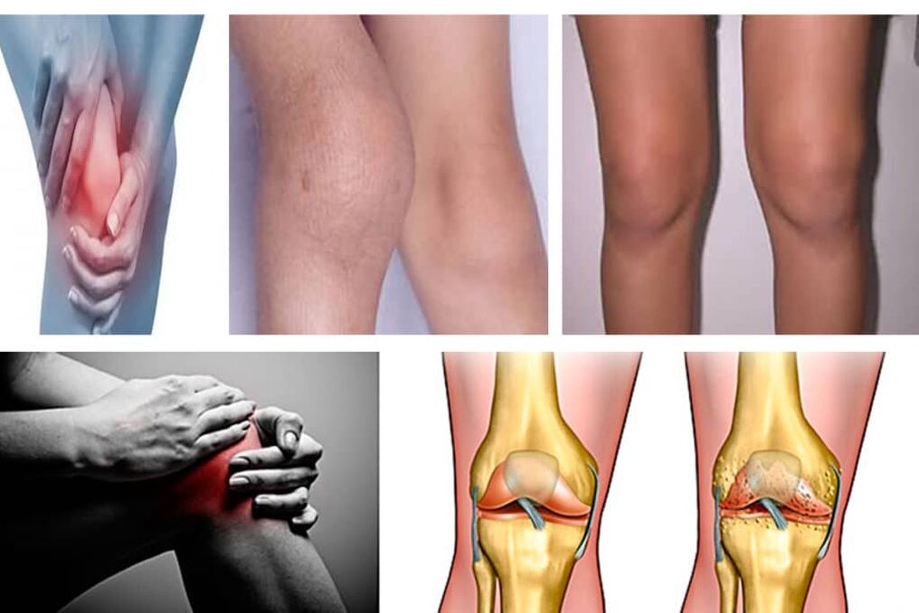 symptoms of osteoarthritis of the knee